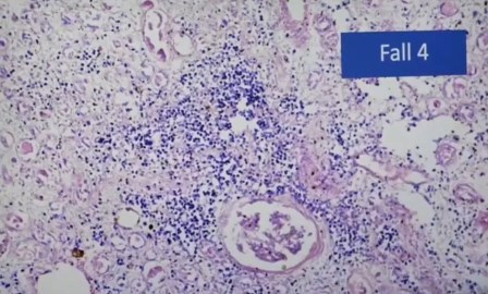 Reutlingen 40 infiltracion nefritis intersticial