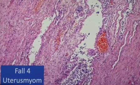 Reutlingen 42 mioma de utero con infiltracion de linfocitos