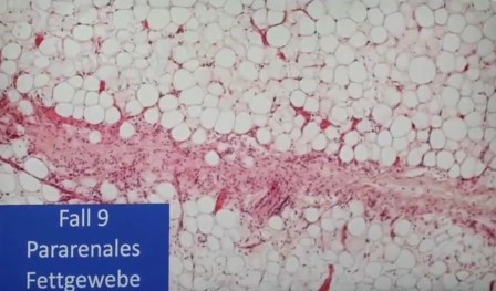 Reutlingen 43 Tejido adiposo pararrenal con infiltracion de linfocitos