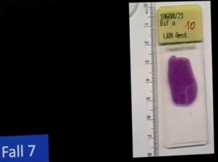 Reutlingen 44 Nodo linfatico de casi cuatro centimetros