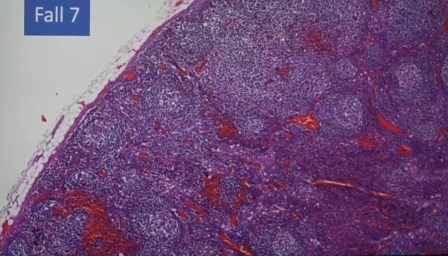 Reutlingen 45 foliculos del nodulo linfatico