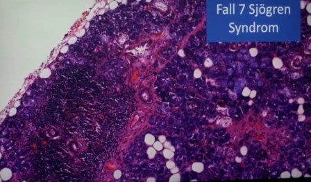 Reutlingen 46 Glandula salival con el tejido muy afectado muy raro sndrome de Sjorgen
