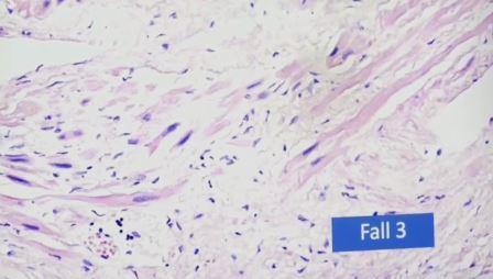 Reutlingen 4 destruccion fibra muscular corazon