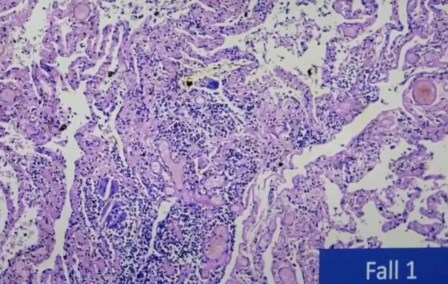 Reutlingen 50 celulas gigantes de cuerpo extrano como macrofagos en alveolitis