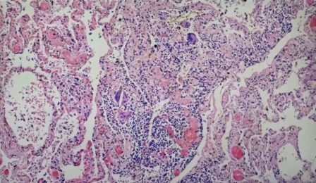 Reutlingen 51 celula gigante 