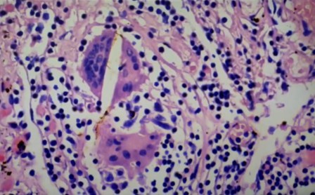 Reutlingen 52 objetos largos marrones metal disuelto en celula