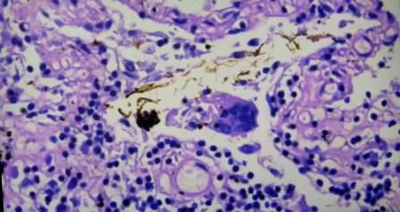 Reutlingen 54 objeto afilado metalico desprendido en la celula gigante