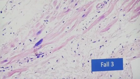 Reutlingen 5 fibra muscular edema corazon