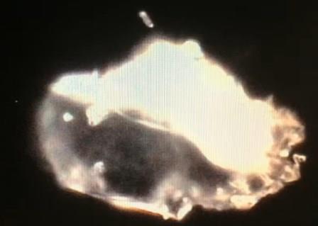 Reutlingen 61 objeto afilado Johnson y Johnson