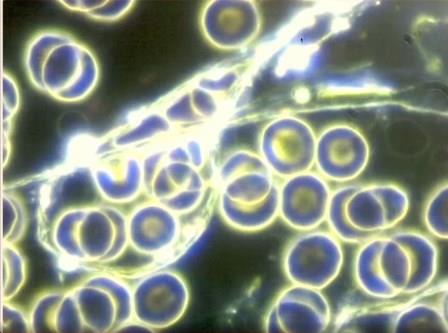 Reutlingen 68 ampliacion grumos eritrocitos