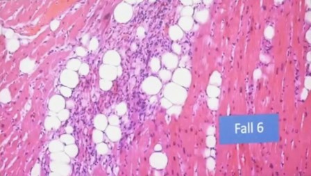 Reutlingen 6 fibra muscular multifocales corazon