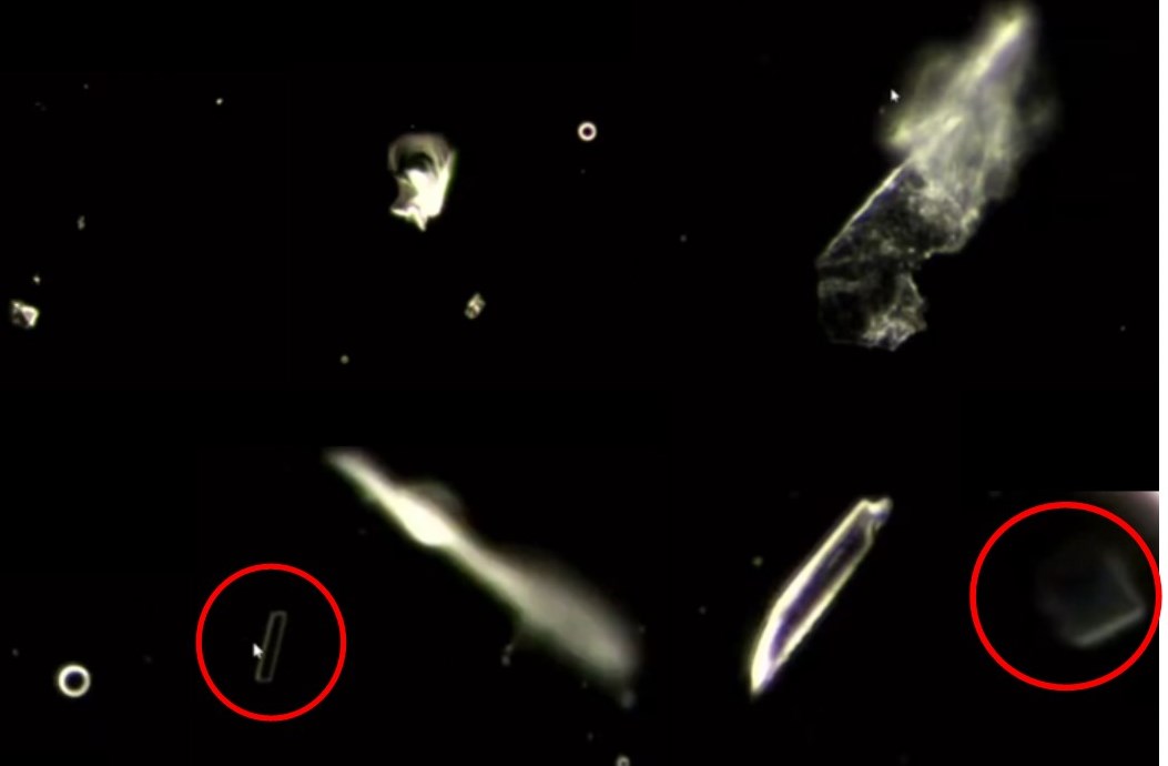 Reutlingen 73 piezzas metalicas y otros en sangre vacunados