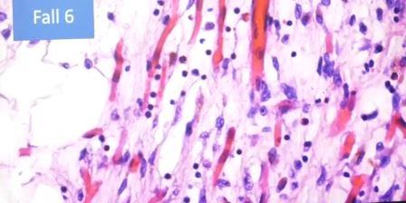 Reutlingen 7 infiltracion de linfocitos corazon