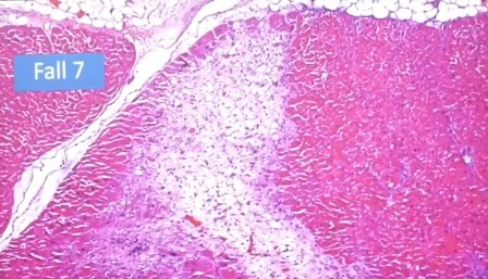 Reutlingen 8 foco de infeccion corazon