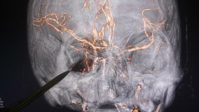 extraccion madero craneo forado INCN