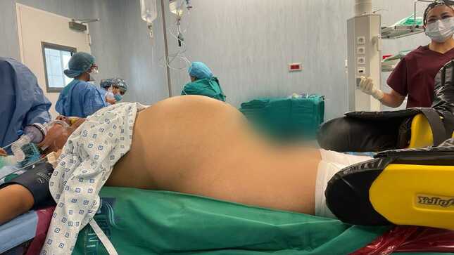 tumor 20 kg IREN Junin antes operacion