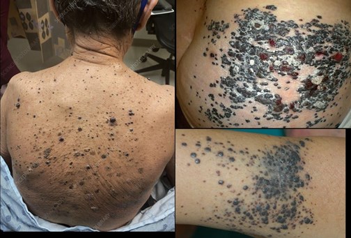 melanoma turbocancer